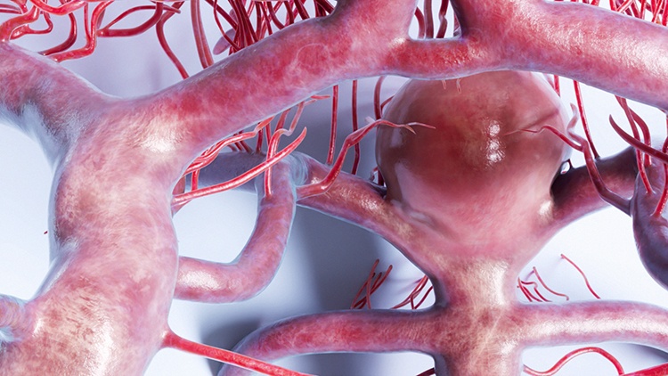 brain aneurysm illusrated on the basilar artery