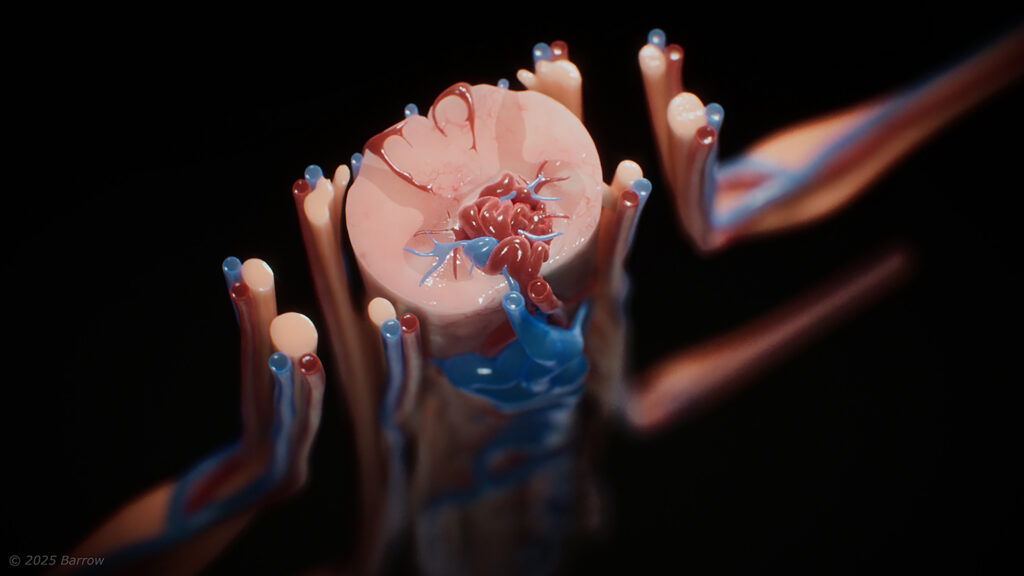 Illustration of an intramedullary spinal arteriovenous malformation showing the tangle of arteries and veins deep within the spinal cord and extending to the surface. In this illustration, red vessels denote arteries, blue vessels denote veins, and purple vessels indicate vessels where oxygenated and deoxygenated blood are mixing near the malformation.