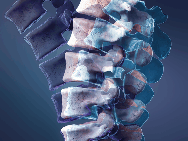 Illustration of the lumbar spine in neutral, flexed, and extended positions.