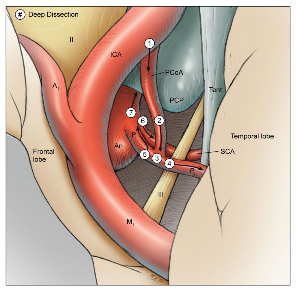 Illustration of a basilar bifurcation aneurysm courtesy of Thieme.