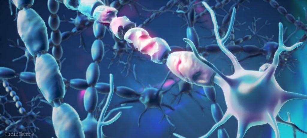 damage to neurons from als