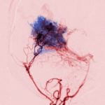 angiogram of arteriovenous malformation embolized with onyx