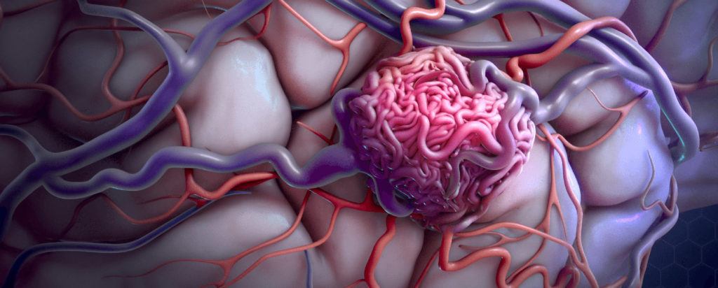 arteriovenous malformation