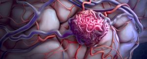 Brain Arteriovenous Malformation (AVM) - Diagnosis and Treatment