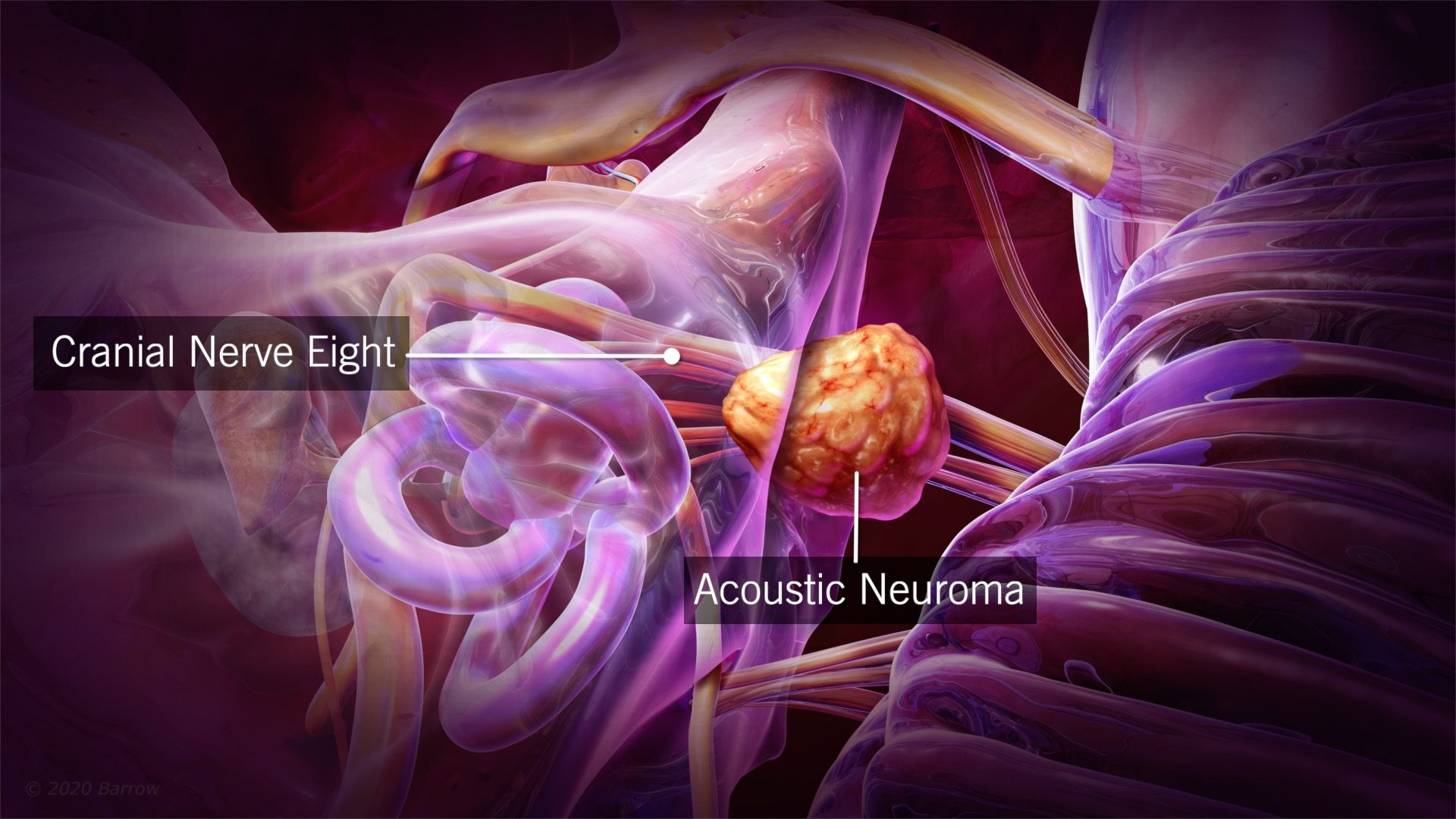 Acoustic Neuroma Diagnosis And Treatment Barrow Neurological Institute