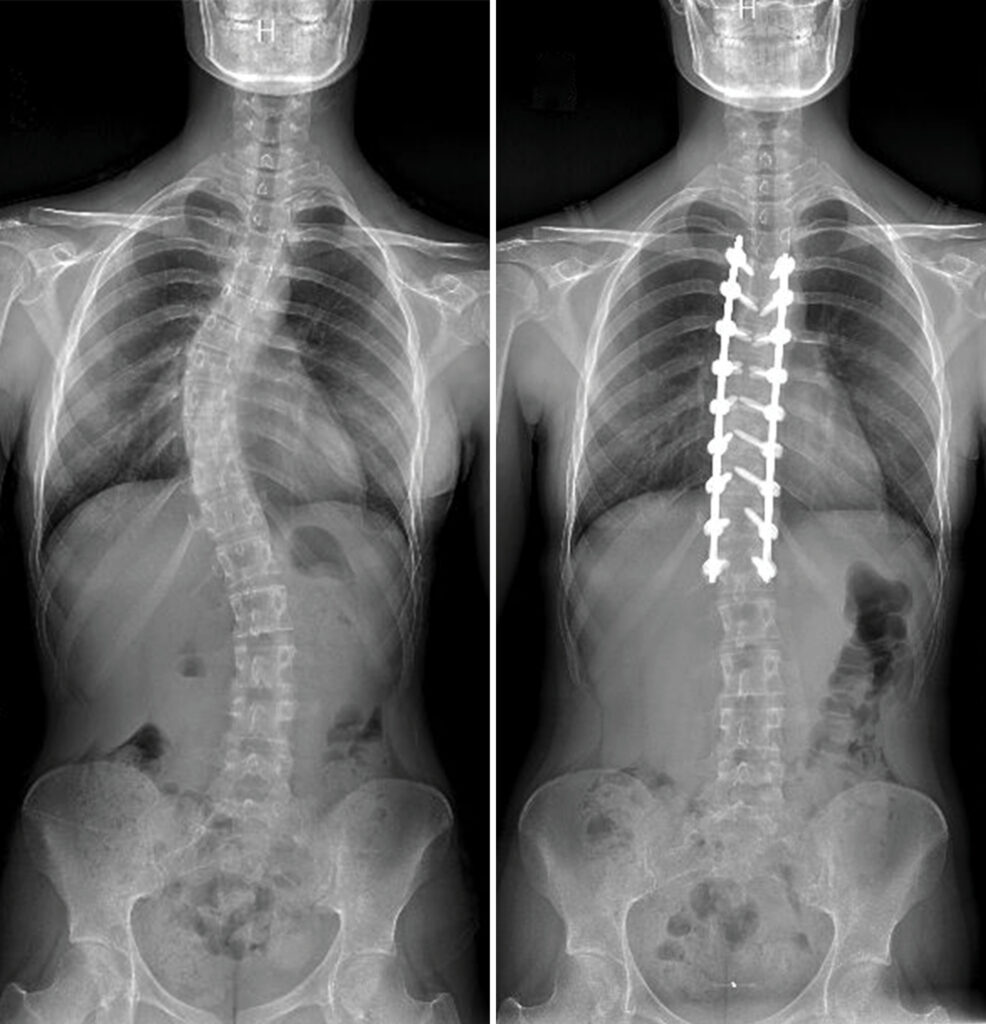 Side-by-side X-rays show Alexandra Wikiera's scoliosis before and after surgery.