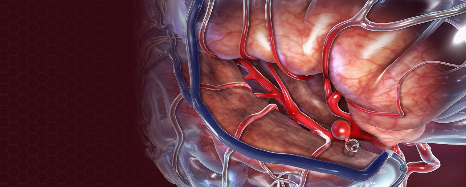brain aneurysm illustration