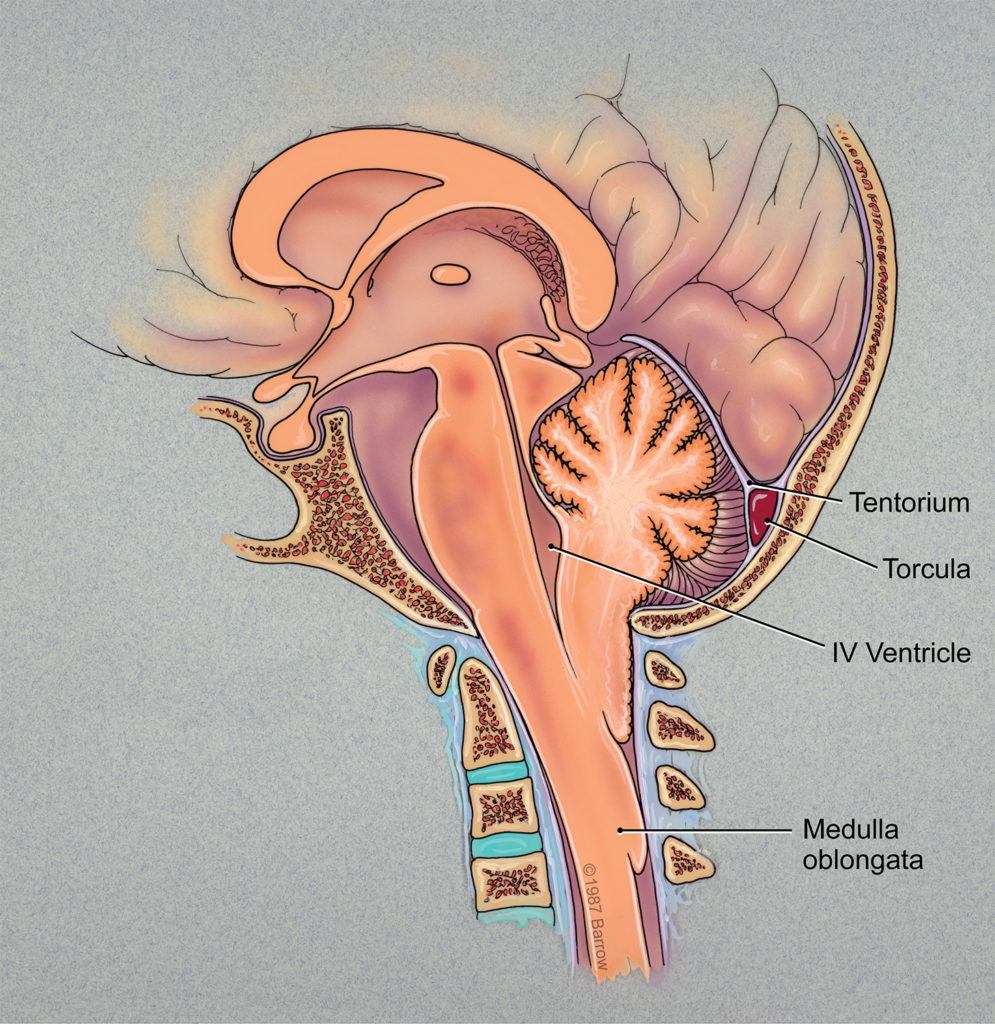 in arnold chiari malformation part of the cerebellum is forced through the foramen magnum and into the spinal canal
