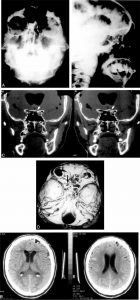 Postpenetrating Trauma Cerebrospinal Fluid Fistula Image