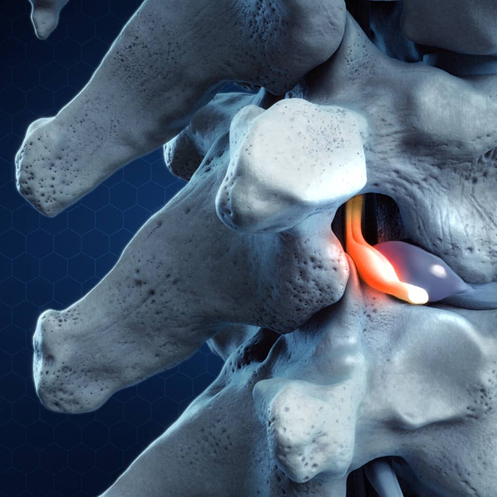 Spine Program - Phoenix, Arizona