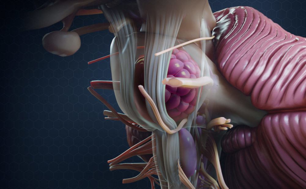 cavernous malformation illustration