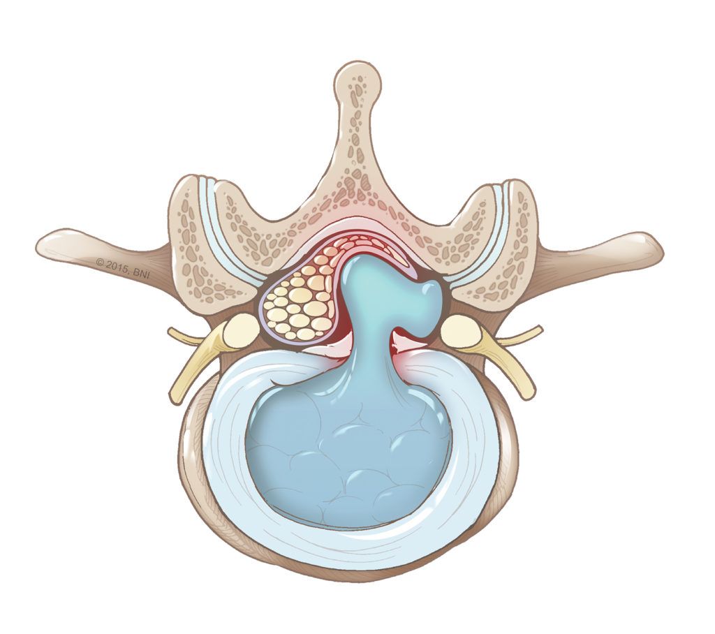 illustration of a herniated lumbar disc showing the soft, gel-like center of the disc squeezing through the tough, outer fiber covering of the disc. The disc is putting pressure on the spinal cord, causing symptoms.