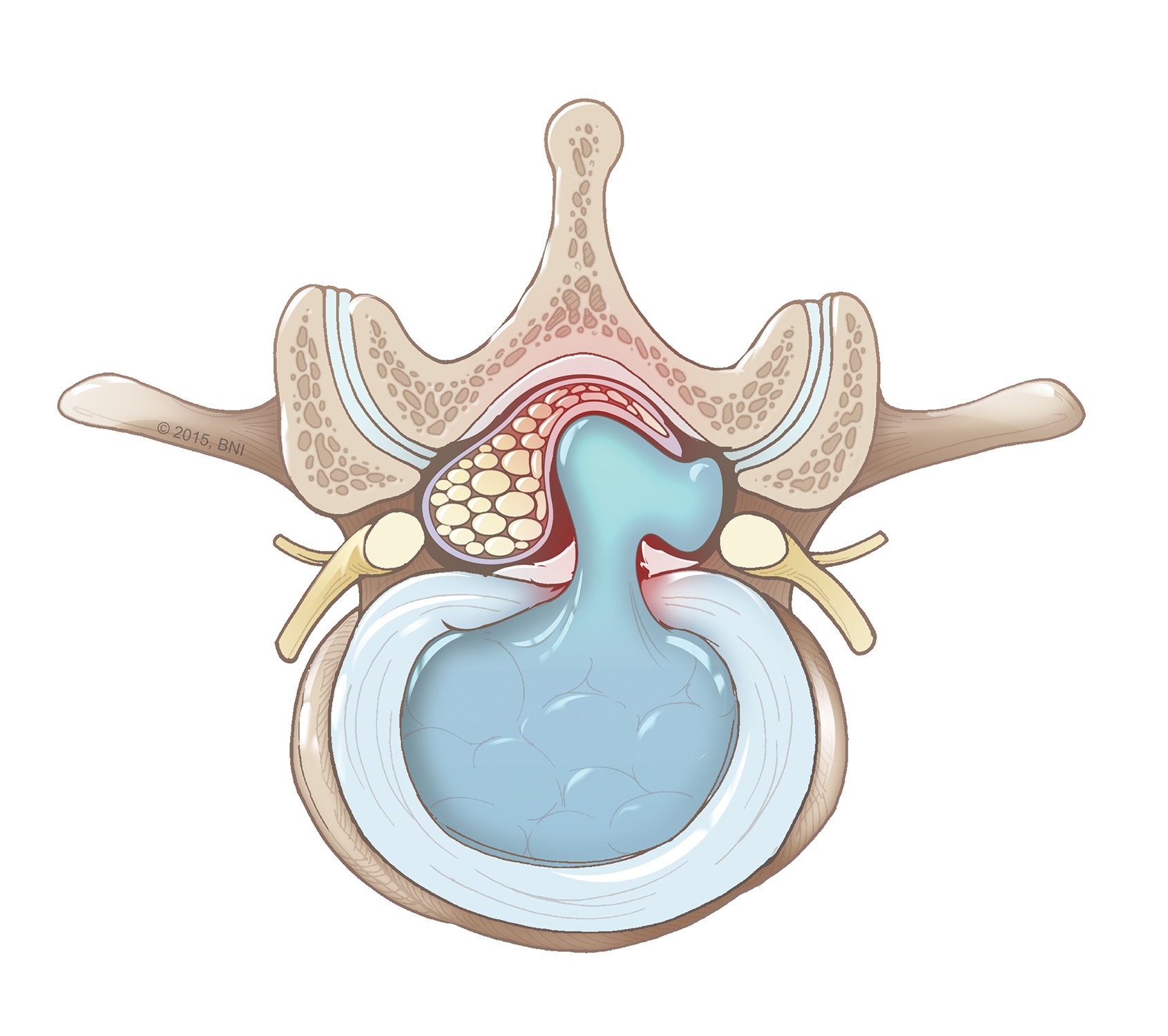 What is a Disc Herniation?  Barrow Neurological Institute