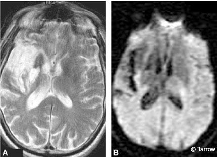 Figure 1. (A) Axial T2-weighted MR image of the brain