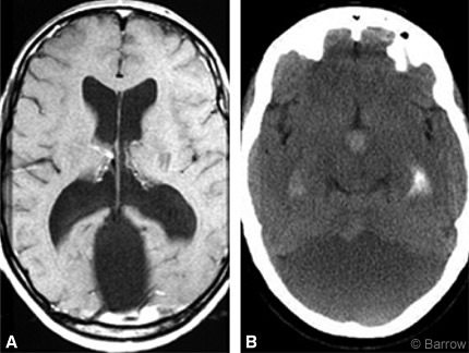 Figure 1. (A) Noncontrasted axial CT scan of the head of a patient with headaches and hallucinations