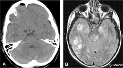 Figure 1. (A) Noncontrasted axial computed tomography (CT) scan