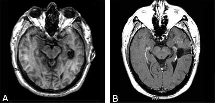 Figure 1. (A) Preoperative axial MR images
