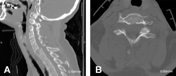 Figure 1. (A) Sagittal and (B) axial reformatted computed tomographic scans