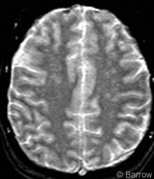 Figure 1. Axial T2-weighted MR image