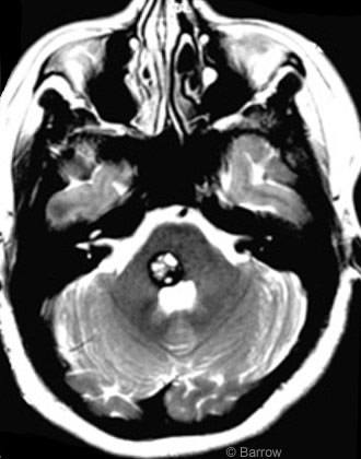Figure 1. Axial T2-weighted magnetic resonance image