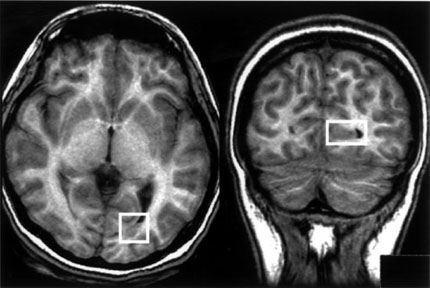 Figure 1. Axial and coronal magnetic resonance images