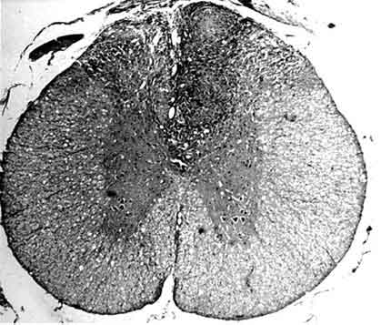 Figure 1. Granuloma replaces the posterior column on the right side of the spinal cord
