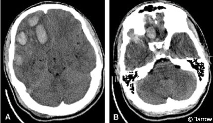 history of craniotomy icd 10 code