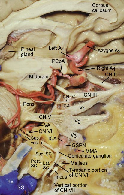 The Middle Fossa Approach | Barrow