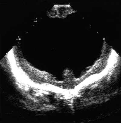 Ultrasonographic image of the infant’s brain