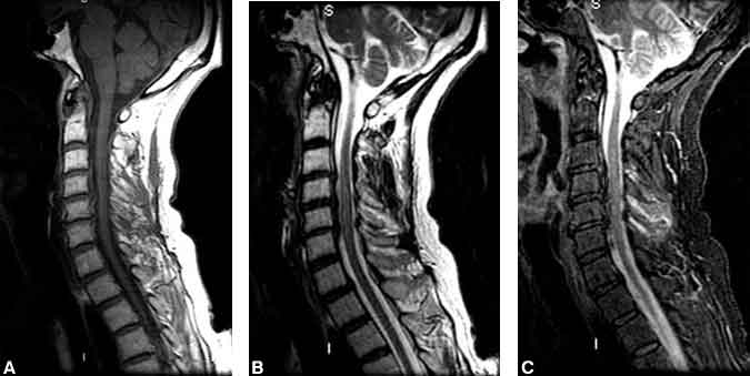Figure 10. (A) Sagittal T1-weighted image of the cervical spine after acute trauma