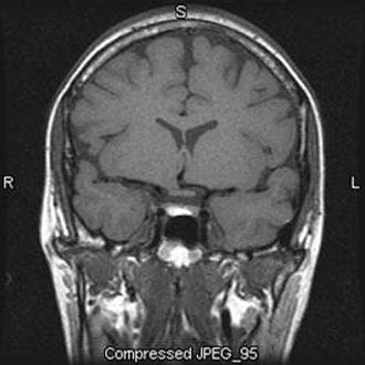Figure 10. (A) Sagittal and (B) coronal noncontrast T1-weighted images