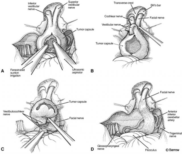 Surgical Approaches for Resection of Acoustic Neuromas Barrow