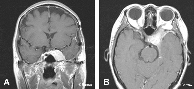 Figure 11. (A) Coronal postcontrast T1-weighted image