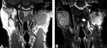 Figure 12. (A) Coronal T1-weighted image showing a large, inferior mass