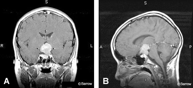 Figure 12. (A) Coronal and (B) sagittal postcontrast T1-weighted images