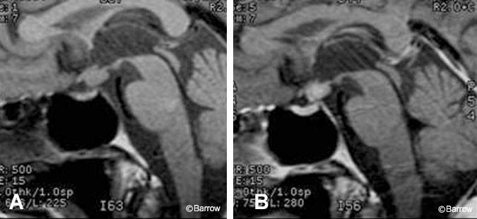 Figure 14. (A) Pre- and (B) postcontrast T1-weighted images