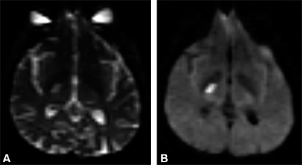 Figure 14. Echo-planar image from a stroke patient
