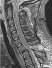 Figure 14. Sagittal magnetic resonance image of the cervical spine