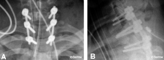 Figure 17. (A) Anteroposterior and (B) lateral plain radiographs