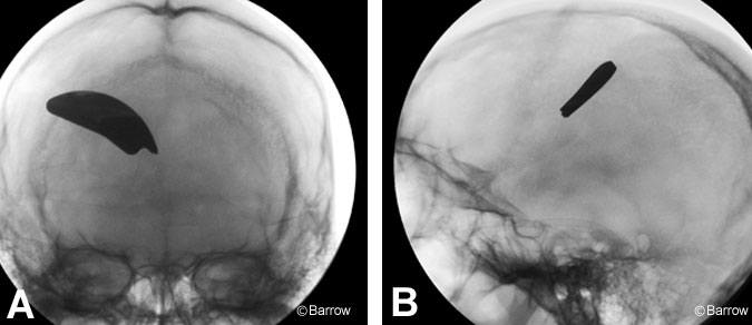 Figure 2. (A) Anteroposterior (B) and lateral skull radiographs