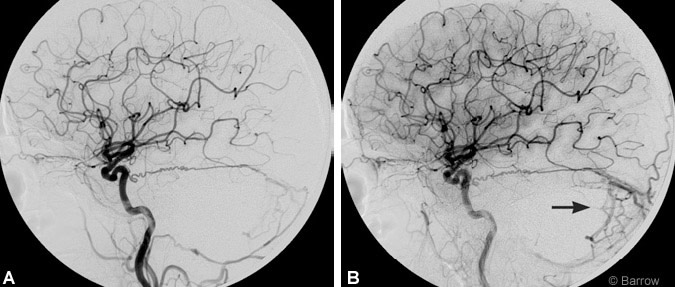 Figure 2. (A) Right common carotid artery angiographic injection