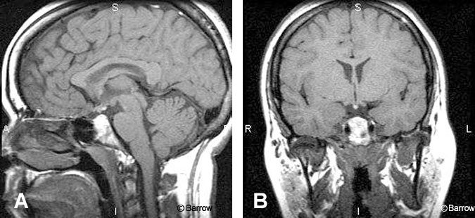 Figure 2. (A) Sagittal and (B) coronal precontrast T1-weighted images