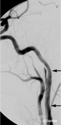 Figure 2. Left lateral common carotid artery angiogram