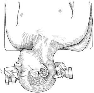 Figure 2. Skin incision for the middle fossa approach