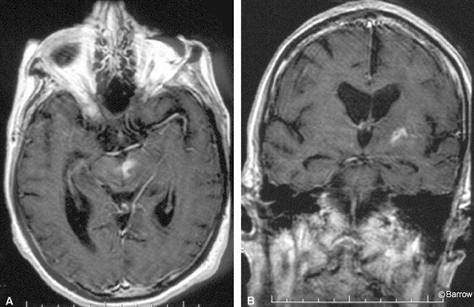 Figure 2. T1-weighted contrast-enhanced (A) axial and (B) coronal magnetic resonance images