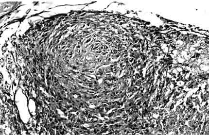Figure 2. The granuloma is composed of spindle cells and epithelioid histiocytes.