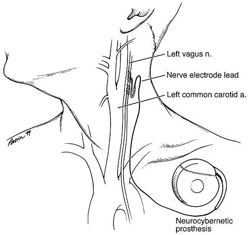 Figure 2. The vagal nerve stimulator unit