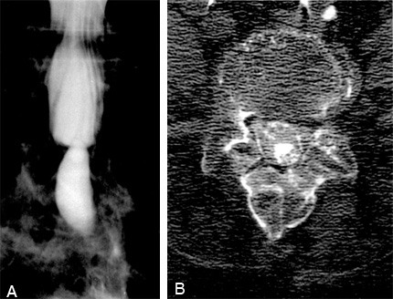 Cureus, Brainstem and Spinal Arachnoiditis Ossificans Associated With  Neurocysticercosis: A Case Report