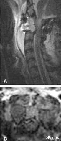 Figure 21. Postoperative (A) sagittal and (B) axial magnetic resonance images