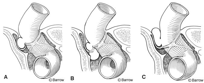 Figure 3. (A) An aneurysm wholly contained within the carotid cave